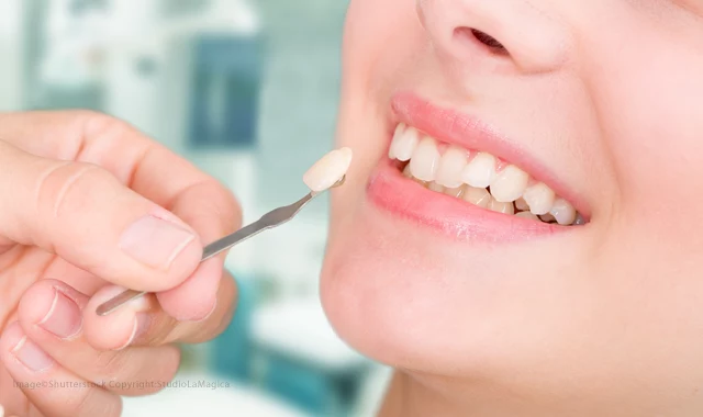 Common dental shading problems and solutions