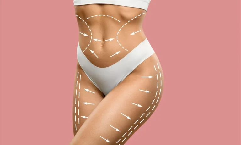 4 Common Misconceptions About Fat Freeze Therapy and Fat Loss Treatment