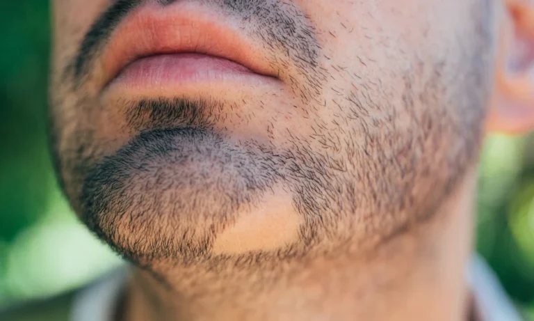 Alopecia Support Should Leave Space for Several Paths